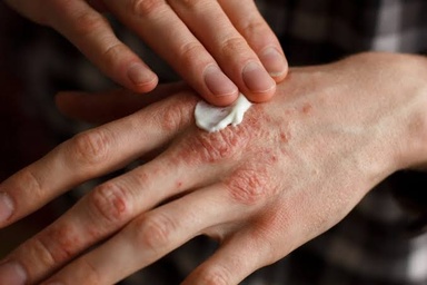 Applying treatment to dry, irritated eczema skin