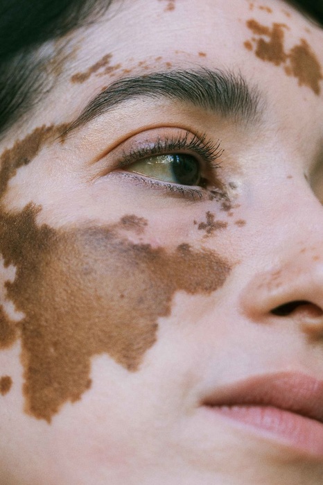 Vitiligo skin condition treated with UVThera