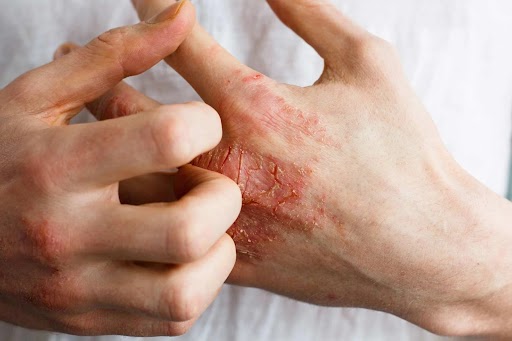 Atopic dermatitis treated with UVThera