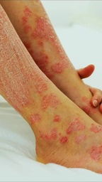 Psoriasis plaques on skin